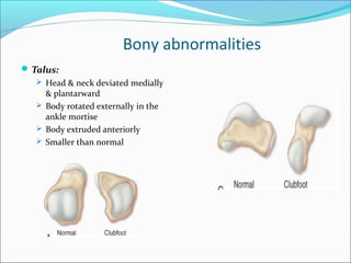 Bony abnormalities
 Talus:
    Head & neck deviated medially
     & plantarward
    Body rotated externally in the
     ankle mortise
    Body extruded anteriorly
    Smaller than normal
 