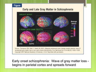 Early onset schizophrenia: Wave of gray matter loss -
begins in parietal cortex and spreads forward
 