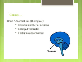 Causes…
Brain Abnormalities (Biological):
* Reduced number of neurons
* Enlarged ventricles
* Thalamus abnormalities
 