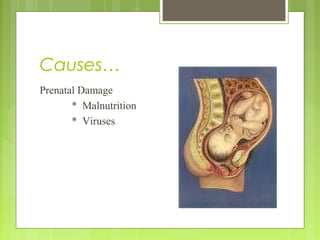 Causes…
Prenatal Damage
* Malnutrition
* Viruses
 