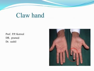 Claw hand

Prof. P.P. Kotwal
DR. pramod
Dr. sushil
 