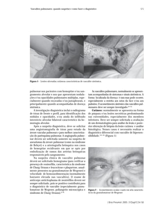 Vasculites pulmonares: quando suspeitar e como fazer o diagnóstico                                                 S5




Figura 1- Lesões ulceradas cutâneas características de vasculite sistêmica.



pulmonar nos pacientes com hemoptise e/ou san-                   As vasculites pulmonares, normalmente se apresen-
gramento alveolar e nos que apresentam nodula-               tam acompanhadas de sintomas e sinais sistêmicos. A
ções e/ou opacidades pulmonares múltiplas, espe-             forma localizada da doença é rara mas pode ocorrer,
cialmente quando escavadas e/ou justapleurais, e             especialmente a restrita aos seios da face e/ou aos
principalmente quando acompanhadas de doença                 pulmões. O acometimento sistêmico das vasculites pul-
sistêmica.                                                   monares deve ser sempre investigado:(9-15)
    A investigação diagnóstica inclui o radiograma               Cutâneo: normalmente se apresenta na forma
de tórax de frente e perfil, para identificação dos          de púrpura e/ou lesões necróticas predominando
nódulos e opacidades, e/ou ainda do infiltrado               nas extremidades, especialmente dos membros
interstício-alveolar bilateral característico da he-         inferiores. Deve ser sempre solicitada a avaliação
morragia alveolar.                                           de um dermatologista para análise da lesão e poste-
    Após a suspeita diagnóstica, deve-se solicitar           rior obtenção de biópsia da lesão cutânea e análise
uma angiotomografia de tórax para estudo da                  histológica. Nesses casos é necessário realizar o
árvore vascular pulmonar e para melhor caracteriza-          diagnóstico diferencial com vasculite de hipersen-
ção do parênquima pulmonar. A angiografia pulmo-             sibilidade. (16-19) (Figura 1)
nar deverá ser solicitada somente na suspeita de
aneurismas da árvore pulmonar (como na síndrome
de Behçet) e a arteriografia brônquica nos casos
de hemoptise recidivante em que se opte por
embolização de ramos das artérias brônquicas
responsáveis pelo sangramento.
    Na suspeita clínica de vasculite pulmonar
deverá ser solicitado hemograma (para verificar a
presença de eosinofilia, característica da síndrome
de Churg-Strauss e leucocitose e plaquetose, usual-
mente presentes na granulomatose de Wegener) e
velocidade de hemossedimentação (normalmente
bastante elevada nas vasculites). O exame de
anticorpo anticitoplasma de neutrófilos deverá ser
sempre solicitado, pois se positivo contribuirá para
o diagnóstico de vasculite (especialmente granu-
lomatose de Wegener, poliangeíte microscópica e              Figura 2 - Acometimento ocular e nariz em sela caracterís-
síndrome de Churg-Strauss).(5-8)                             ticos da granulomatose de Wegener



                                                                                 J Bras Pneumol. 2005; 31(Supl1):S4-S8
 