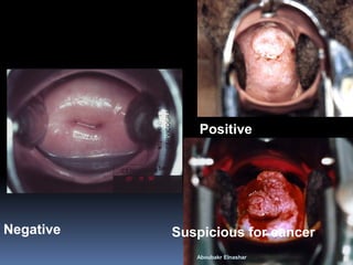 Negative 
Positive 
Suspicious for cancer 
Aboubakr Elnashar  