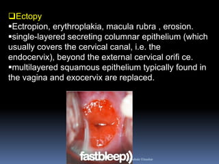 Ectopy 
Ectropion, erythroplakia, macula rubra , erosion. 
single-layered secreting columnar epithelium (which usually covers the cervical canal, i.e. the endocervix), beyond the external cervical orifi ce. 
multilayered squamous epithelium typically found in the vagina and exocervix are replaced. 
Aboubakr Elnashar  