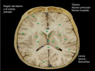 Región del tálamo
y el cuerpo
estriado
Límite
lateral -
Diencéfalo
Tálamo
Núcleo Lenticular
Núcleo Caudado
 