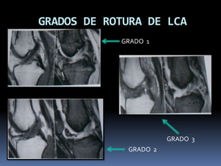 GRADOS DE ROTURA DE LCA
GRADO 1
GRADO 2
GRADO 3
 