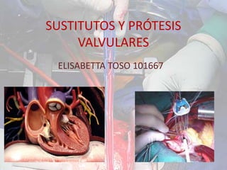 SUSTITUTOS Y PRÓTESIS
VALVULARES
ELISABETTA TOSO 101667
 
