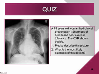 QUIZ
A 75 years old woman had clinical
presentation : Shortness of
breath and poor exercise
tolerance. The CXR shows
beside.
1. Please describe this picture!
2. What is the most likely
diagnosis of this patient?
14
 