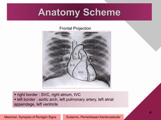 Anatomy Scheme
4
Meschan, Synopsis of Rontgen Signs
 right border : SVC, right atrium, IVC
 left border : aortic arch, left pulmonary artery, left atrial
appendage, left ventricle
Frontal Projection
Sudarmo, Pemeriksaan Kardiovaskular
 