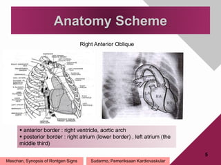 5
Anatomy Scheme
Meschan, Synopsis of Rontgen Signs
Right Anterior Oblique
 anterior border : right ventricle, aortic arch
 posterior border : right atrium (lower border) , left atrium (the
middle third)
Sudarmo, Pemeriksaan Kardiovaskular
 