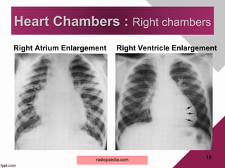 Right Atrium Enlargement Right Ventricle Enlargement
10
Heart Chambers : Right chambers
radiopaedia.com
 
