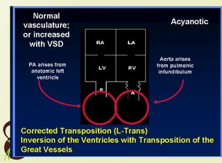 Sutton 7 transposition of the great arteries | PPT