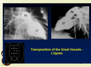 Sutton 7 transposition of the great arteries | PPT