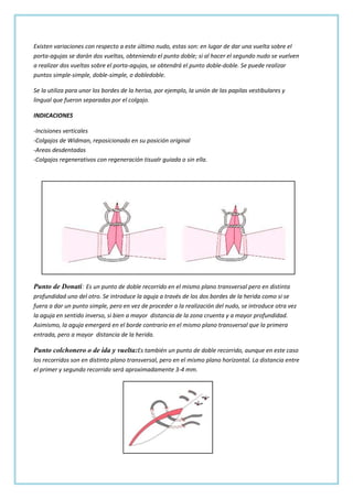Existen variaciones con respecto a este último nudo, estas son: en lugar de dar una vuelta sobre el
porta-agujas se darán dos vueltas, obteniendo el punto doble; si al hacer el segundo nudo se vuelven
a realizar dos vueltas sobre el porta-agujas, se obtendrá el punto doble-doble. Se puede realizar
puntos simple-simple, doble-simple, o dobledoble.
Se la utiliza para unor los bordes de la herisa, por ejemplo, la unión de las papilas vestibulares y
lingual que fueron separadas por el colgajo.
INDICACIONES
-Incisiones verticales
-Colgajos de Widman, reposicionado en su posición original
-Areas desdentadas
-Colgajos regenerativos con regeneración tisualr guiada o sin ella.

Punto de Donati: Es un punto de doble recorrido en el mismo plano transversal pero en distinta
profundidad uno del otro. Se introduce la aguja a través de los dos bordes de la herida como si se
fuera a dar un punto simple, pero en vez de proceder a la realización del nudo, se introduce otra vez
la aguja en sentido inverso, si bien a mayor distancia de la zona cruenta y a mayor profundidad.
Asimismo, la aguja emergerá en el borde contrario en el mismo plano transversal que la primera
entrada, pero a mayor distancia de la herida.

Punto colchonero o de ida y vuelta:Es también un punto de doble recorrido, aunque en este caso
los recorridos son en distinto plano transversal, pero en el mismo plano horizontal. La distancia entre
el primer y segundo recorrido será aproximadamente 3-4 mm.

 