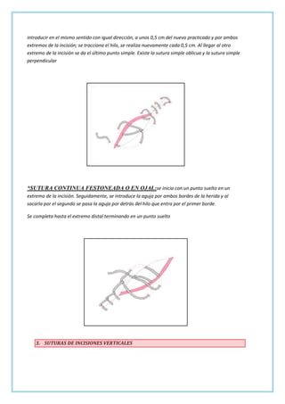 introducir en el mismo sentido con igual dirección, a unos 0,5 cm del nuevo practicado y por ambos
extremos de la incisión; se tracciona el hilo, se realiza nuevamente cada 0,5 cm. Al llegar al otro
extremo de la incisión se da el último punto simple. Existe la sutura simple oblicua y la sutura simple
perpendicular

*SUTURA CONTINUA FESTONEADA O EN OJAL:se inicia con un punto suelto en un
extremo de la incisión. Seguidamente, se introduce la aguja por ambos bordes de la herida y al
sacarla por el segundo se pasa la aguja por detrás del hilo que entra por el primer borde.
Se completa hasta el extremo distal terminando en un punto suelto

3. SUTURAS DE INCISIONES VERTICALES

 
