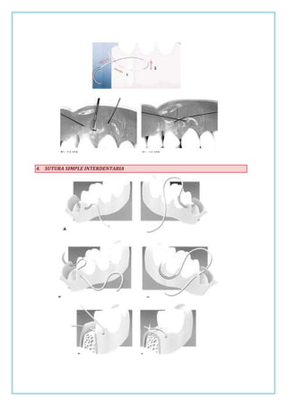 4. SUTURA SIMPLE INTERDENTARIA

 