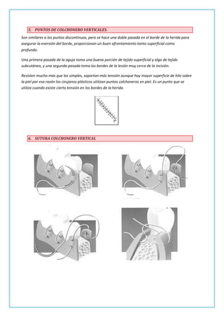 5. PUNTOS DE COLCHONERO VERTICALES.
Son similares a los puntos discontinuos, pero se hace una doble pasada en el borde de la herida para
asegurar la eversión del borde, proporcionan un buen afrontamiento tanto superficial como
profundo.
Una primera pasada de la aguja toma una buena porción de tejido superficial y algo de tejido
subcutáneo, y una segunda pasada toma los bordes de la lesión muy cerca de la incisión.
Resisten mucho más que los simples, soportan más tensión aunque hay mayor superficie de hilo sobre
la piel por esa razón los cirujanos plásticos utilizan puntos colchoneros en piel. Es un punto que se
utiliza cuando existe cierta tensión en los bordes de la herida.

6. SUTURA COLCHONERO VERTICAL

 