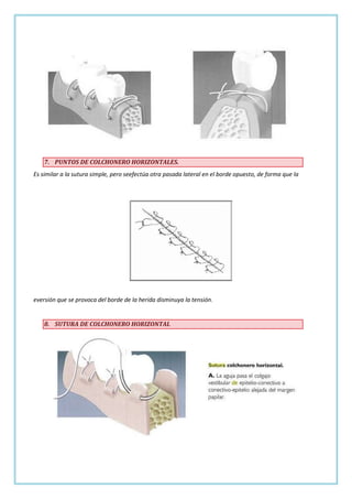 7. PUNTOS DE COLCHONERO HORIZONTALES.
Es similar a la sutura simple, pero seefectúa otra pasada lateral en el borde opuesto, de forma que la

eversión que se provoca del borde de la herida disminuya la tensión.

8. SUTURA DE COLCHONERO HORIZONTAL

 