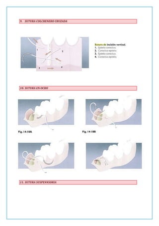 9. SUTURA COLCHENERO CRUZADA

10. SUTURA EN OCHO

11. SUTURA SUSPENNSORIA

 