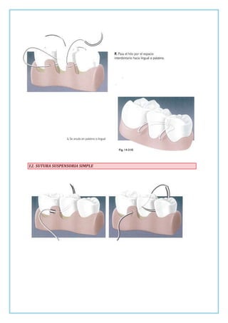 12. SUTURA SUSPENSORIA SIMPLE

 