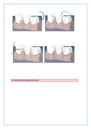 13. SUTURA SUPENSORIA CONTINUA

 