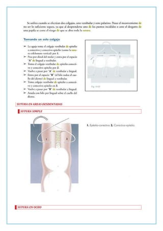 SUTURA EN AREAS DESDENTADAS
SUTURA SIMPLE

SUTURA EN OCHO

 