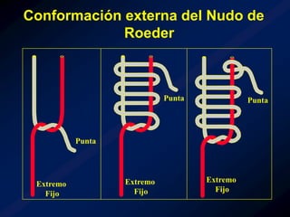 Tipos de suturas y nudos en cirugia general y laparoscopica | PPT