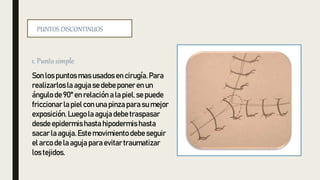 Son los puntos masusados en cirugía. Para
realizarlos la aguja se debe poner en un
ángulo de 90° en relación a la piel, se puede
friccionarla piel con una pinzapara su mejor
exposición. Luego la aguja debe traspasar
desde epidermishastahipodermis hasta
sacar la aguja. Este movimiento debe seguir
el arco de la aguja para evitar traumatizar
los tejidos.
PUNTOS DISCONTINUOS
 