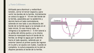 Utilizado para disminuir y redistribuir
tensión, cerrar el tercer espacio y para
vertir los bordes de la herida. Inicialmente
se coloca la aguja 4 - 10 mm del borde de
la herida, pasándola por la epidermis y
dermis hacia el lado contralateral,
saliendo en ese lado a una distancia del
borde de la herida igual a la tomada en el
lado inicial. En ese mismo lado, se
reingresa a la epidermis 3 - 5 mm lateral a
la salida del último punto y a la misma
distancia manejada hacia el borde de la
herida; se dirige la aguja por la dermis
hacia el lado opuesto, saliendo por al
exterior lateral al primer punto de ingreso
en la piel y se ajusta con nudos. Cuando se
completa, la sutura expuesta en la piel se
dispone paralela al borde de la herida.
 