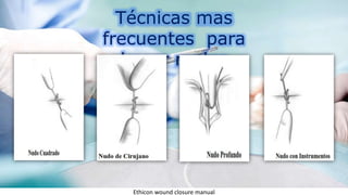 Técnicas mas
frecuentes para
hacer nudos
Ethicon wound closure manual
 
