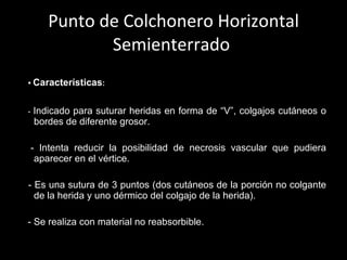 Punto de Colchonero Horizontal Semienterrado    -   Indicado para suturar heridas en forma de “V”, colgajos cutáneos o bordes de diferente grosor. - Intenta reducir la posibilidad de necrosis vascular que pudiera aparecer en el vértice. - Es una sutura de 3 puntos (dos cutáneos de la porción no colgante de la herida y uno dérmico del colgajo de la herida). - Se realiza con material no reabsorbible.   •  Características : 