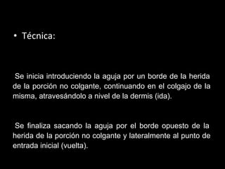 Técnica:   - Se inicia introduciendo la aguja por un borde de la herida de la porción no colgante, continuando en el colgajo de la misma, atravesándolo a nivel de la dermis (ida). - Se finaliza sacando la aguja por el borde opuesto de la herida de la porción no colgante y lateralmente al punto de entrada inicial (vuelta).   