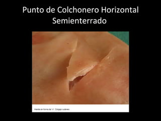 Punto de Colchonero Horizontal Semienterrado  