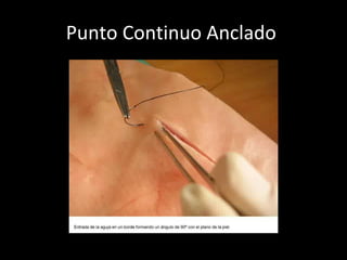 Punto Continuo Anclado  