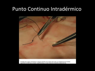 Punto Continuo Intradérmico  