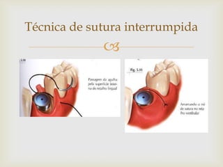 Técnica de sutura interrumpida