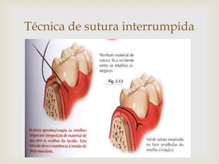 Técnica de sutura interrumpida