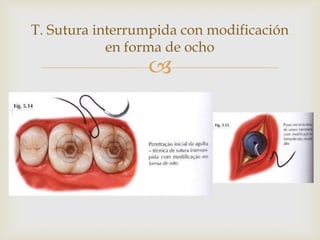 T. Sutura interrumpida con modificación en forma de ocho
