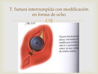 T. Sutura interrumpida con modificación en forma de ocho