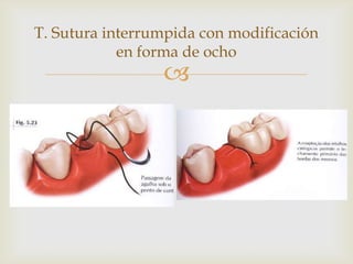 T. Sutura interrumpida con modificación en forma de ocho