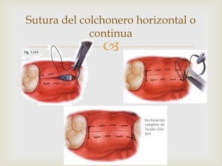 Sutura del colchonero horizontal o continua