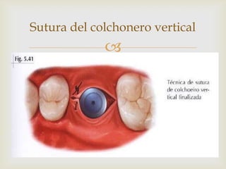 Sutura del colchonero vertical