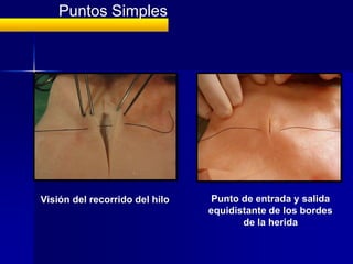 Puntos Simples




Visión del recorrido del hilo   Punto de entrada y salida
                                equidistante de los bordes
                                       de la herida
 