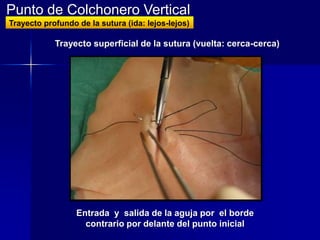 Punto de Colchonero Vertical
Trayecto profundo de la sutura (ida: lejos-lejos)

            Trayecto superficial de la sutura (vuelta: cerca-cerca)




                  Entrada y salida de la aguja por el borde
                    contrario por delante del punto inicial
 