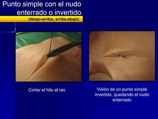 Punto de Colchonero Vertical
Trayecto profundo de la sutura (ida: lejos-lejos)

           Trayecto superficial de la sutu...