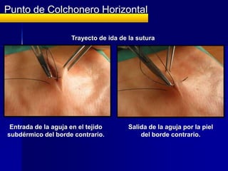 Punto de Colchonero Horizontal
               Semienterrado
    Características:


     Indicado para suturar heridas en ...