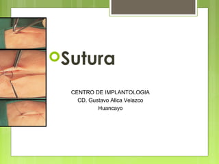 Sutura
CENTRO DE IMPLANTOLOGIA
CD. Gustavo Allca Velazco
Huancayo

 