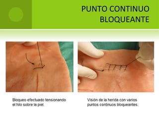 PUNTO CONTINUO 
BLOQUEANTE

 