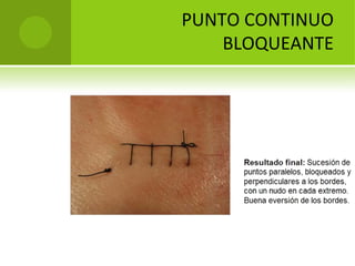 PUNTO CONTINUO 
BLOQUEANTE

 