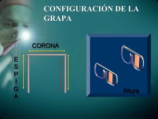 CONFIGURACIÓN DE LA
GRAPA
CORONA
E
S
P
I
G
A
Altura
 